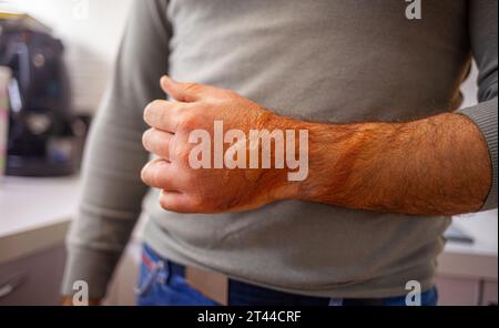 La main d'un homme brûlait avec de l'eau bouillante. Dessus, il y a des rougeurs et des cloques. Banque D'Images