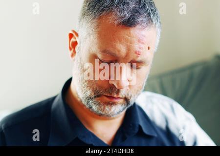 Homme avec herpès Zoster (bardeaux) sur le visage, gros plan. homme souffrant d'herpès sur le visage. Banque D'Images