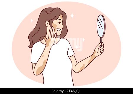 Femme souriante avec le regard de vitiligo dans le miroir sentiment du corps positif. Bonne fille avec la maladie de peau se sentir satisfait et optimiste. Soins de la peau et dermatologie. Illustration vectorielle. Illustration de Vecteur