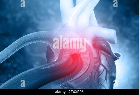 Angioplastie cardiaque humaine. illustration 3d. Banque D'Images