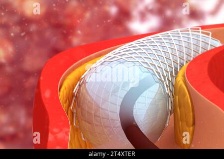 Angioplastie et pose de stent. illustration 3d. Banque D'Images