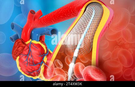 Angioplastie cardiaque humaine. illustration 3d. Banque D'Images