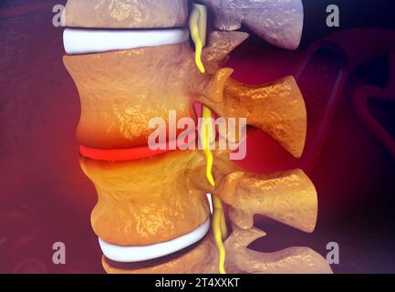 Rachis humain avec disque glissé sur fond de science médicale. illustration 3d. Banque D'Images