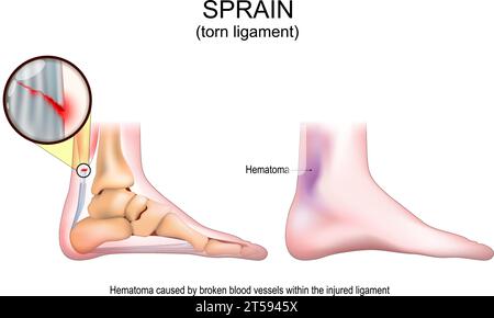 Entorse. Ligament déchiré après torsion douloureuse du pied. Signes et symptômes d'une lésion des tissus mous. Lésion musculaire, déchirure tendineuse, description du problème ligamentaire. Illustration de Vecteur