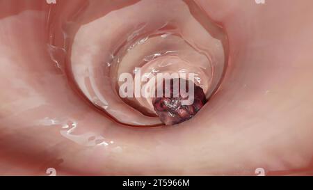 Cancer colorectal, tumeur maligne dans l'intestin, endoscope dans la coloscopie, intestin intestinal, ablation de polypes du côlon, recherche de polypes du côlon, polypectomie, Banque D'Images