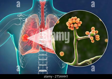 Lésion mucormycosique pulmonaire, illustration Banque D'Images