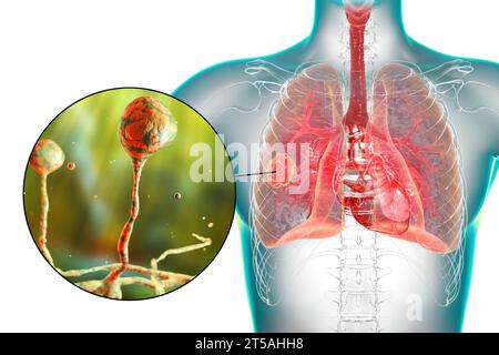 Lésion mucormycosique pulmonaire, illustration Banque D'Images