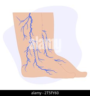 Concept variqueux. Gonflement et douleur dans les jambes féminines. Diagnostic et traitement des maladies vasculaires. Tension artérielle anormale, faiblesse de la veine et des valves. VE Illustration de Vecteur