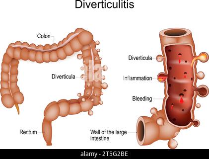 Diverticulite colique. Coupe transversale d'un côlon avec saignement et inflammation de poches anormales ou de diverticules. maladie gastro-intestinale. La humaine Illustration de Vecteur