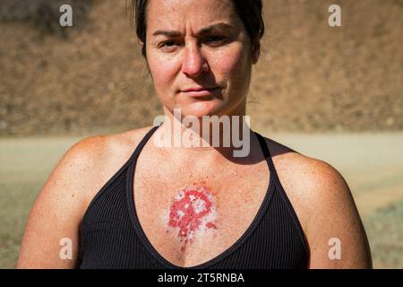 femme caucasienne de 30s présentant un carcinome basocellulaire superficiel réagissant à un traitement à la crème imiquimod après une utilisation régulière montrant une lésion rouge sur la poitrine. Banque D'Images