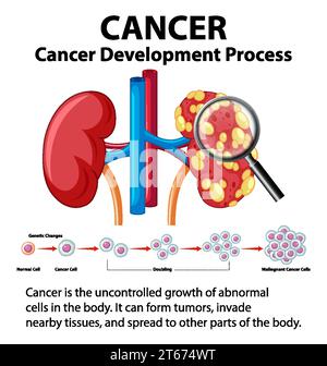 Infographie illustrée illustrant le processus de développement du cancer dans le rein humain Illustration de Vecteur