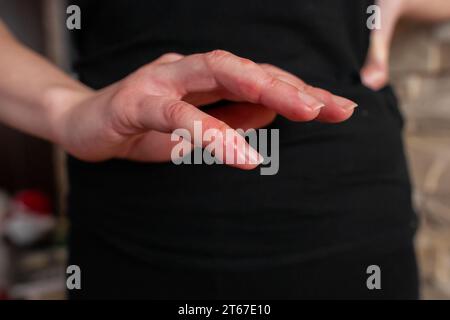 Chilblains sur les doigts, bosses rouges démangeaisons main d'une personne avec phénomène de Raynaud et lésions chilblains avec doigts gonflés Perniose main gonflée Banque D'Images