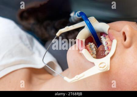 Vue de dessus rapprochée de la bouche d'une femme portant des bretelles de ligature. Alignement et correction de morsure. Conception de l'orthodontie et de l'odontologie. Banque D'Images