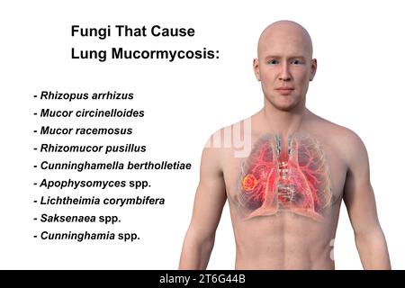 Une illustration photoréaliste 3D de la moitié supérieure d'un homme à la peau transparente, révélant une lésion de mucormycose pulmonaire. Banque D'Images