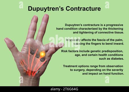 Une illustration médicale 3D montrant la main d'un patient atteint de la maladie de Dupuytren, mettant l'accent sur les tendons et le fascia palmaire affectés pour illustrer l Banque D'Images