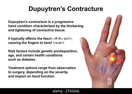 Une illustration médicale 3D montrant la main d'un patient atteint de la maladie de Dupuytren, mettant l'accent sur les tendons et le fascia palmaire affectés pour illustrer l Banque D'Images