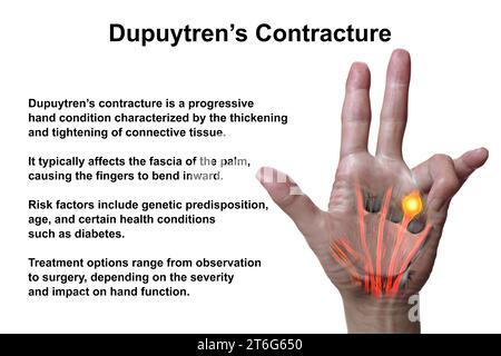 Une illustration médicale 3D montrant la main d'un patient atteint de la maladie de Dupuytren, mettant l'accent sur les tendons et le fascia palmaire affectés pour illustrer l Banque D'Images