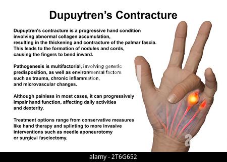 Une illustration médicale 3D montrant la main d'un patient atteint de la maladie de Dupuytren, mettant l'accent sur les tendons et le fascia palmaire affectés pour illustrer l Banque D'Images