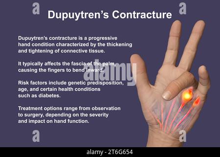 Une illustration médicale 3D montrant la main d'un patient atteint de la maladie de Dupuytren, mettant l'accent sur les tendons et le fascia palmaire affectés pour illustrer l Banque D'Images