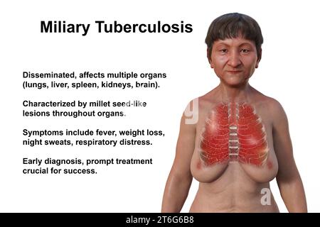 Une illustration photoréaliste 3D de la moitié supérieure d'une femme à la peau transparente, montrant les poumons atteints de miliaire tuberculeuse. Banque D'Images