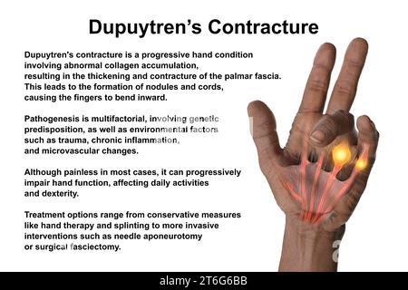Une illustration médicale 3D montrant la main d'un patient atteint de la maladie de Dupuytren, mettant l'accent sur les tendons et le fascia palmaire affectés pour illustrer l Banque D'Images