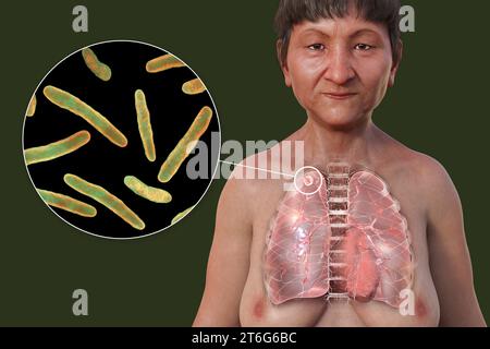 Une illustration 3D montrant la moitié supérieure d'une patiente avec la peau transparente, révélant les poumons affectés par la tuberculose secondaire et cl Banque D'Images