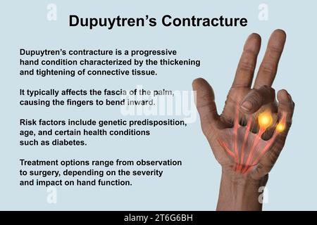 Une illustration médicale 3D montrant la main d'un patient atteint de la maladie de Dupuytren, mettant l'accent sur les tendons et le fascia palmaire affectés pour illustrer l Banque D'Images