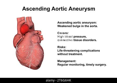 Un cœur humain avec un anévrisme aortique ascendant, illustration 3D soulignant la dilatation et les risques potentiels pour la santé associés à la condition Banque D'Images