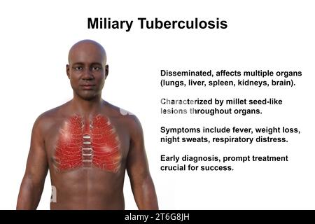 Une illustration photoréaliste 3D de la moitié supérieure d'un homme à la peau transparente, montrant les poumons atteints de miliaire tuberculeuse Banque D'Images