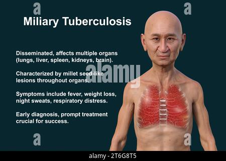 Une illustration photoréaliste 3D de la moitié supérieure d'un homme à la peau transparente, montrant les poumons atteints de miliaire tuberculeuse Banque D'Images