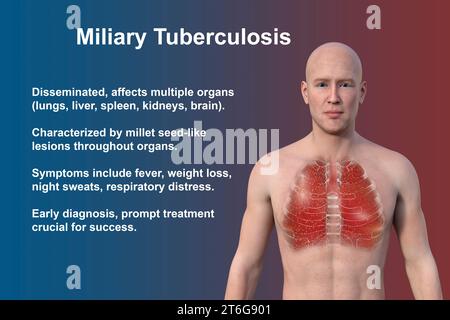 Une illustration photoréaliste 3D montrant la moitié supérieure d’un homme à la peau transparente, révélant les poumons atteints de miliaire tuberculeuse Banque D'Images
