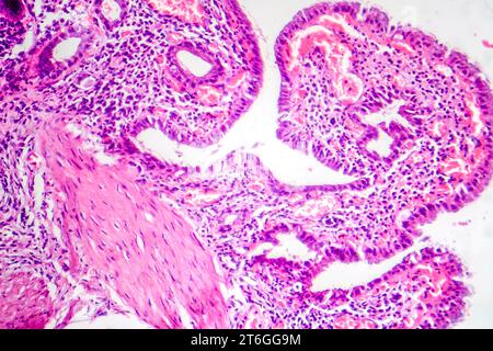 Photomicrographie de la cholécystite chronique mettant en évidence une inflammation et des modifications structurales de la paroi vésiculaire. Banque D'Images