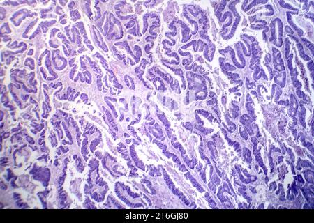 Photomicrographie d'un carcinome épidermoïde de l'oesophage, montrant des cellules squameuses malignes caractéristiques du cancer de l'oesophage. Banque D'Images