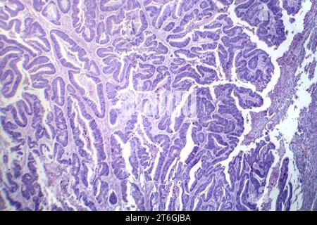 Photomicrographie d'un carcinome épidermoïde de l'oesophage, montrant des cellules squameuses malignes caractéristiques du cancer de l'oesophage. Banque D'Images