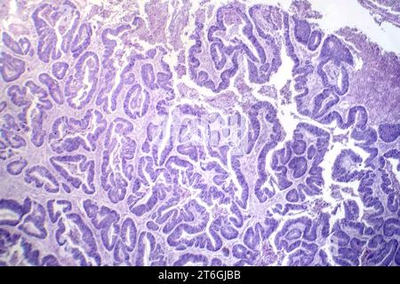 Photomicrographie d'un carcinome épidermoïde de l'oesophage, montrant des cellules squameuses malignes caractéristiques du cancer de l'oesophage. Banque D'Images