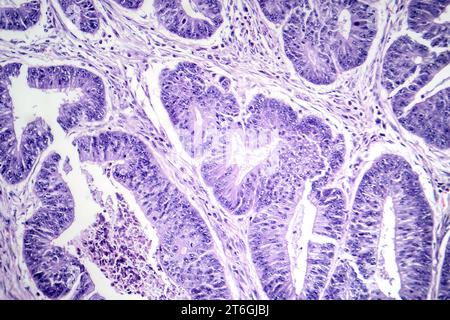 Photomicrographie d'un carcinome épidermoïde de l'oesophage, montrant des cellules squameuses malignes caractéristiques du cancer de l'oesophage. Banque D'Images