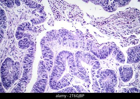 Photomicrographie d'un carcinome épidermoïde de l'oesophage, montrant des cellules squameuses malignes caractéristiques du cancer de l'oesophage. Banque D'Images