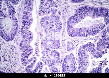 Photomicrographie d'un carcinome épidermoïde de l'oesophage, montrant des cellules squameuses malignes caractéristiques du cancer de l'oesophage. Banque D'Images