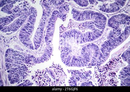 Photomicrographie d'un carcinome épidermoïde de l'oesophage, montrant des cellules squameuses malignes caractéristiques du cancer de l'oesophage. Banque D'Images