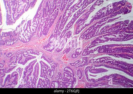 Photomicrographie d'adénocarcinome colique illustrant les cellules glandulaires malignes caractéristiques du cancer colique. Banque D'Images