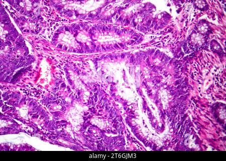 Photomicrographie d'adénocarcinome colique illustrant les cellules glandulaires malignes caractéristiques du cancer colique. Banque D'Images