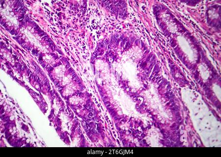 Photomicrographie d'adénocarcinome colique illustrant les cellules glandulaires malignes caractéristiques du cancer colique. Banque D'Images