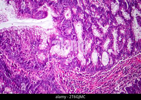 Photomicrographie d'adénocarcinome colique illustrant les cellules glandulaires malignes caractéristiques du cancer colique. Banque D'Images