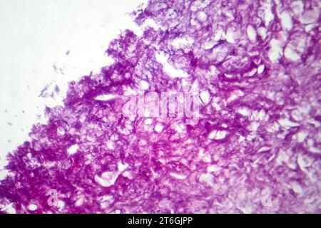 Photomicrographie du mélanome, mettant en évidence les mélanocytes malins, les cellules primaires responsables du cancer agressif de la peau. Banque D'Images