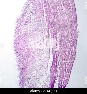 Photomicrographie du mélanome, mettant en évidence les mélanocytes malins, les cellules primaires responsables du cancer agressif de la peau. Banque D'Images
