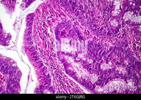 Photomicrographie d'adénocarcinome colique illustrant les cellules glandulaires malignes caractéristiques du cancer colique. Banque D'Images