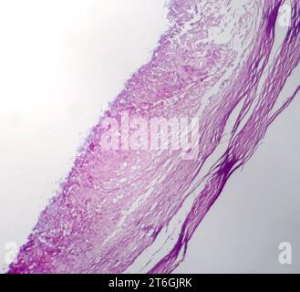 Photomicrographie du mélanome, mettant en évidence les mélanocytes malins, les cellules primaires responsables du cancer agressif de la peau. Banque D'Images