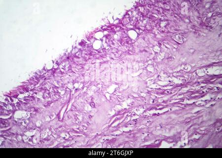 Photomicrographie du mélanome, mettant en évidence les mélanocytes malins, les cellules primaires responsables du cancer agressif de la peau. Banque D'Images