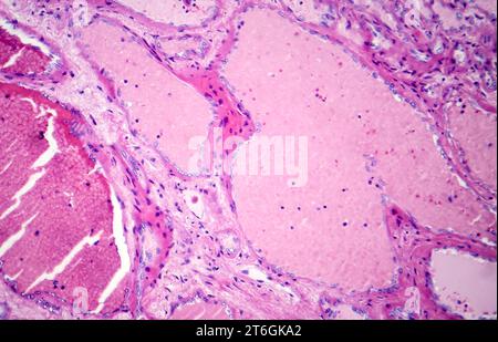 Photomicrographie d'hémangiome caverneux hépatique, représentant des vaisseaux sanguins dilatés dans le tissu hépatique, caractéristique d'une tumeur bénigne. Banque D'Images