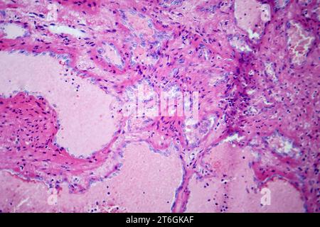 Photomicrographie d'hémangiome caverneux hépatique, représentant des vaisseaux sanguins dilatés dans le tissu hépatique, caractéristique d'une tumeur bénigne. Banque D'Images